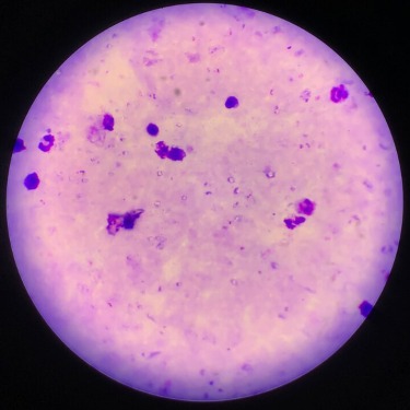 Malaria